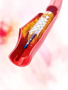 Chirurgie Vasculară 6 Poza reprezentativa proceduri medicale angioplastia cu balon la Clinica Venart.