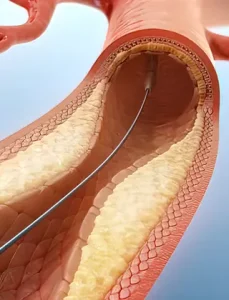 Chirurgie Vasculară 7 Poza Reprezentativa Carduri Proceduri Medicale VenArt Stentare Arteriala