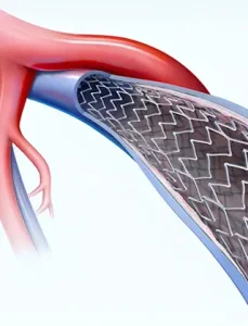 Chirurgie Vasculară 8 Poza reprezentativa proceduri medicale stentarea venoasa la Clinica Venart.