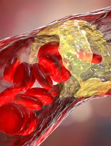 Chirurgie Vasculară 10 Poza reprezentativa proceduri medicale trombectomie endovasculara la clinica venart.