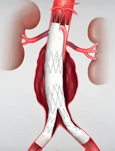 Chirurgie Vasculară 11 Repararea Endovasculară a Anevrismelor Aortice (EVAR)