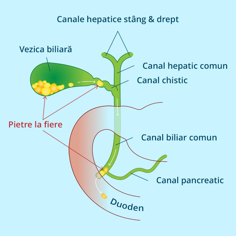 Poza explicativa pentru Operatia de Colecist la Clinica VenArt.