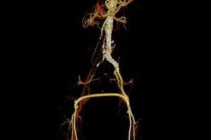 Representative image for hybrid procedures for complex mixed aortic and common iliac artery pathologies
