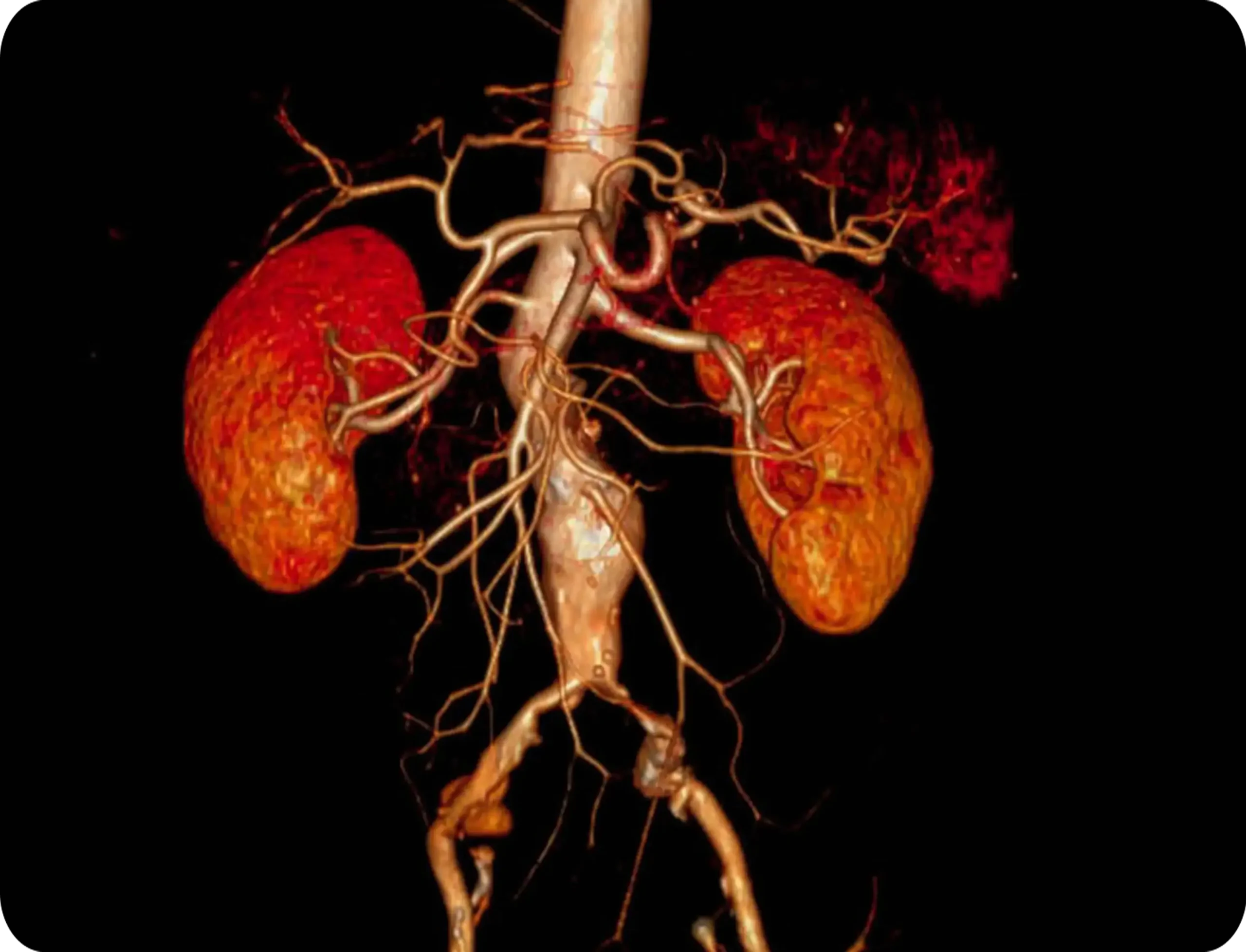The picture shows a swollen avevrism.