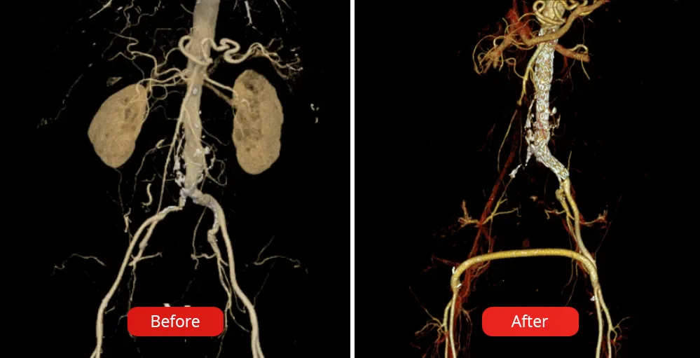 Representative photo before and after hybrid surgery for complex mixed pathologies and aneurysms