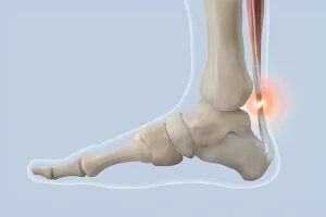 Representative image for the article Achilles tendon.