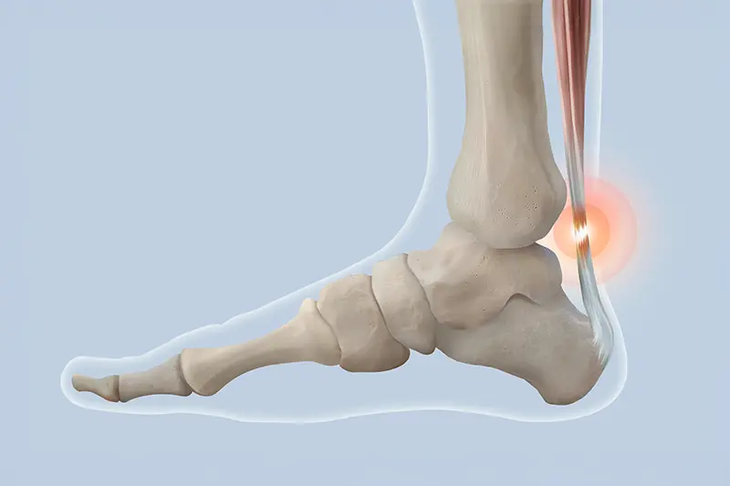 Representative image for the article Achilles tendon.
