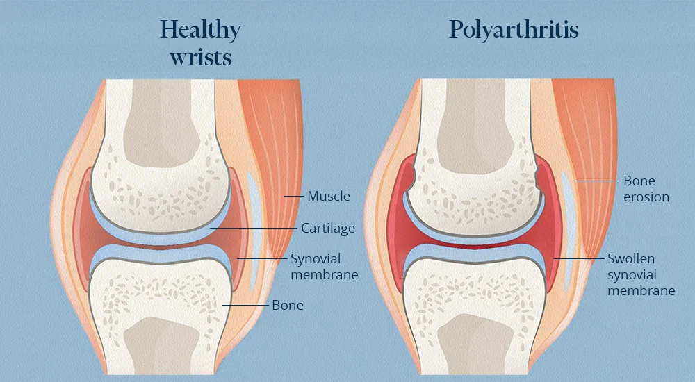 The difference between a healthy joint and a joint with rheumatoid arthritis