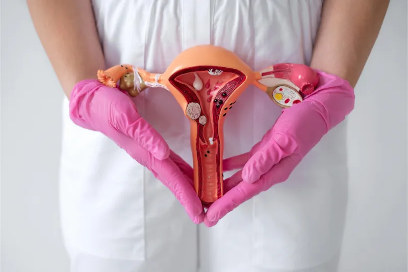 Poza reprezentativa pentru procedura de tratament endometrioza.