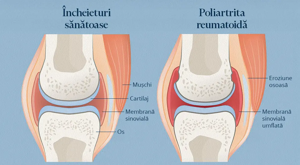 Diferenta intre articulatie sanatoasa si articulatie cu poliartrita reumatoida