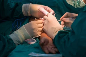 Poza reprezentativa pentru malformatie arterio-venoasa.