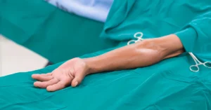 Braț pregătit pentru intervenția de creare a fistulei arteriovenoase, în sala de operație