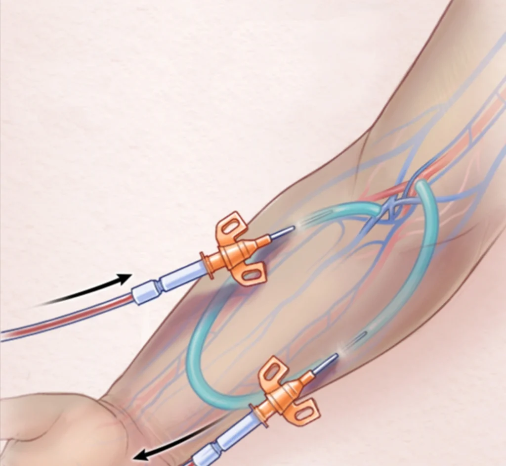 Poza reprezentativa cu procesul pentr Fistula Arteriovenoasa.