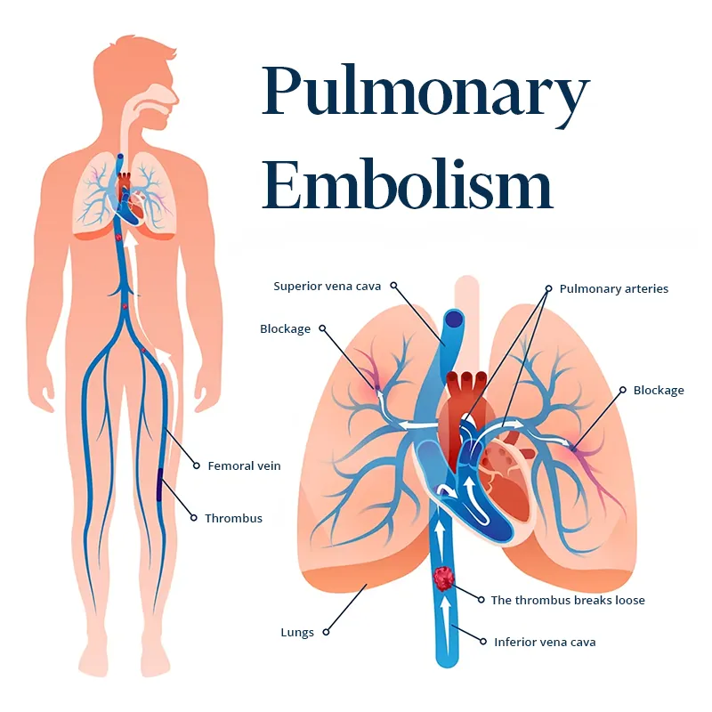 Detailed graphic drawing illustrating pulmonary embolism.