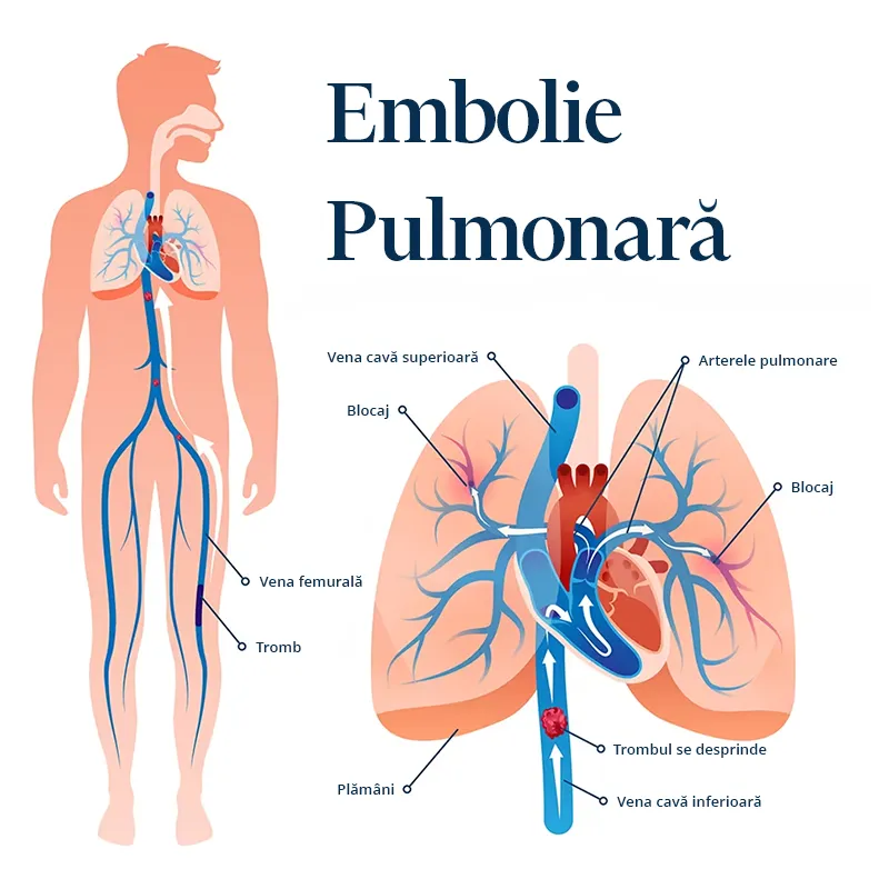Desen grafic detaliat care ilustrează embolia pulmonară.