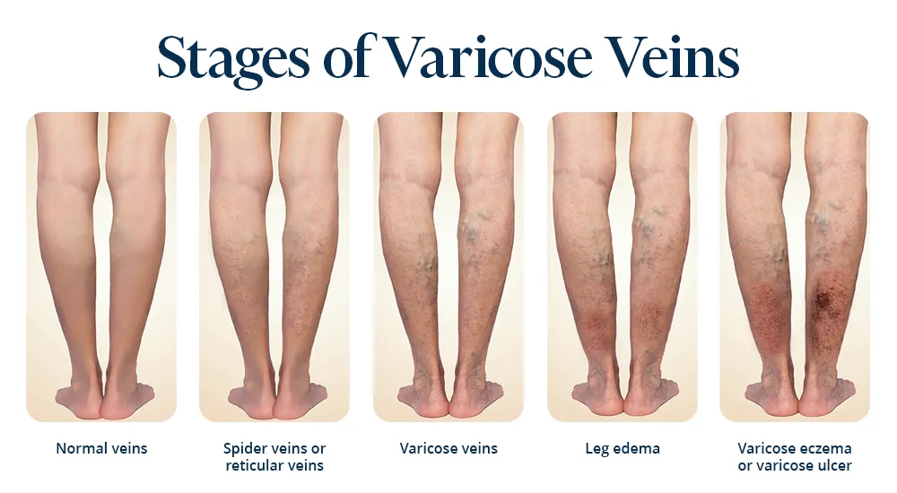 Infografic picture with legs of a woman showing all the stages of varicose veins