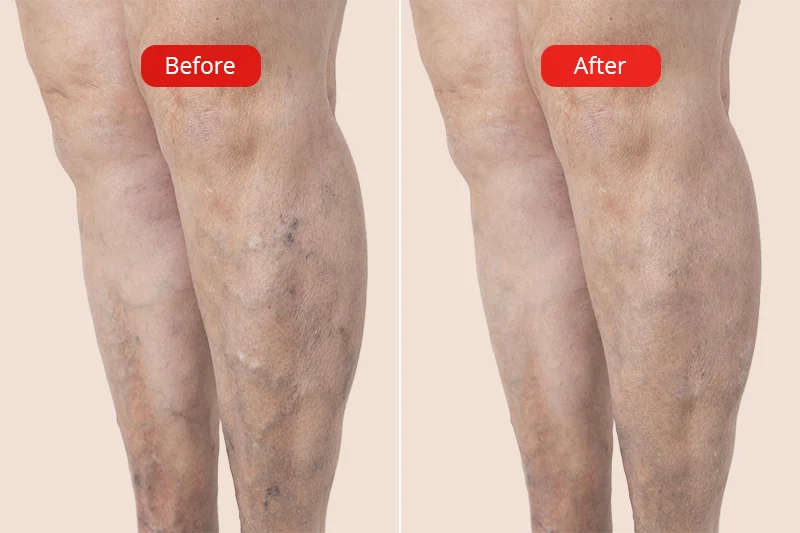 Representative photo showing the legs before and after treatment with VNUS radiofrequency.