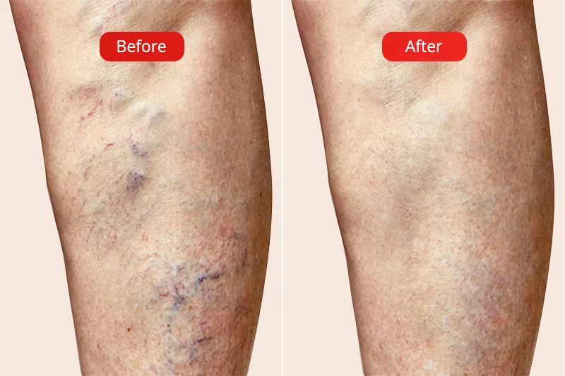 Before and after Venosteam treatment method at VenArt medical clinic