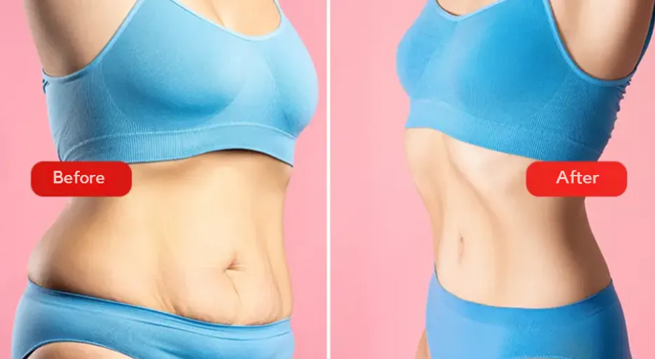 Before and after abdominoplasty procedure at VenArt Clinic