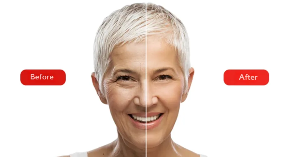 The photo shows the results before and after the botulinum toxin Botox procedure at the Venart clinic.