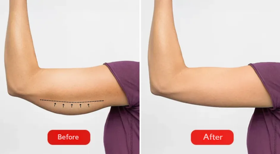 The photo shows the results before and after the brahioplasty procedure at the Venart clinic.