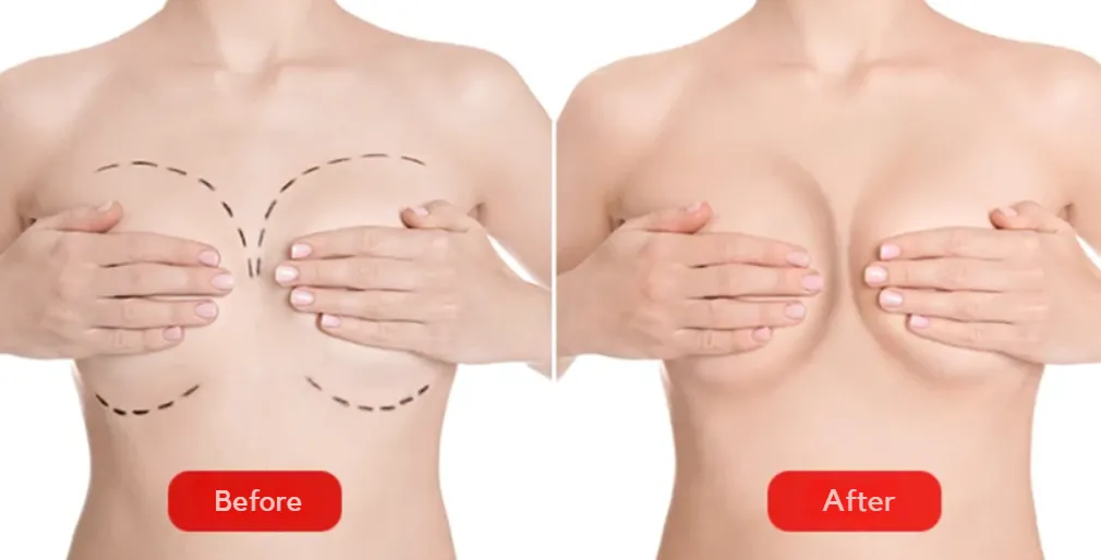 Breast reconstruction before and after