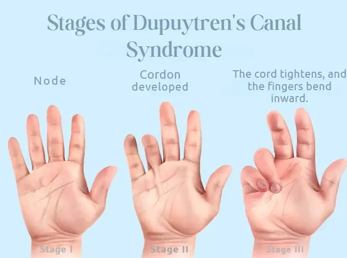 The picture shows the stages of Dupuytren's contracture. Dupuytren's disease pictures