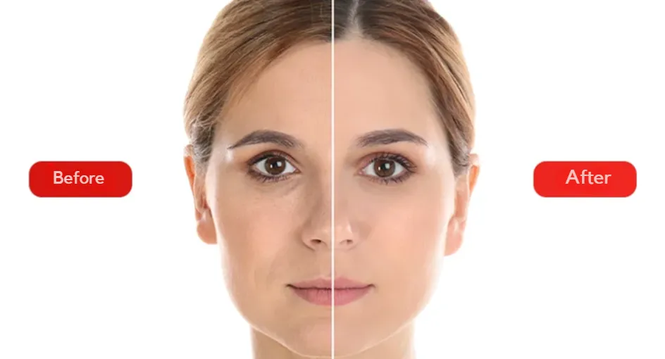 The photo shows before and after the facial rejuvenation procedure with hyaluronic acid.