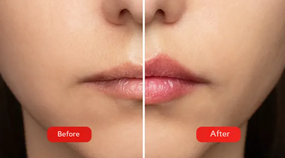 Representative photo for the lip augmentation procedure with hyaluronic acid, showing the results before and after the procedure. 0.5 ml lip shaping with hyaluronic acid