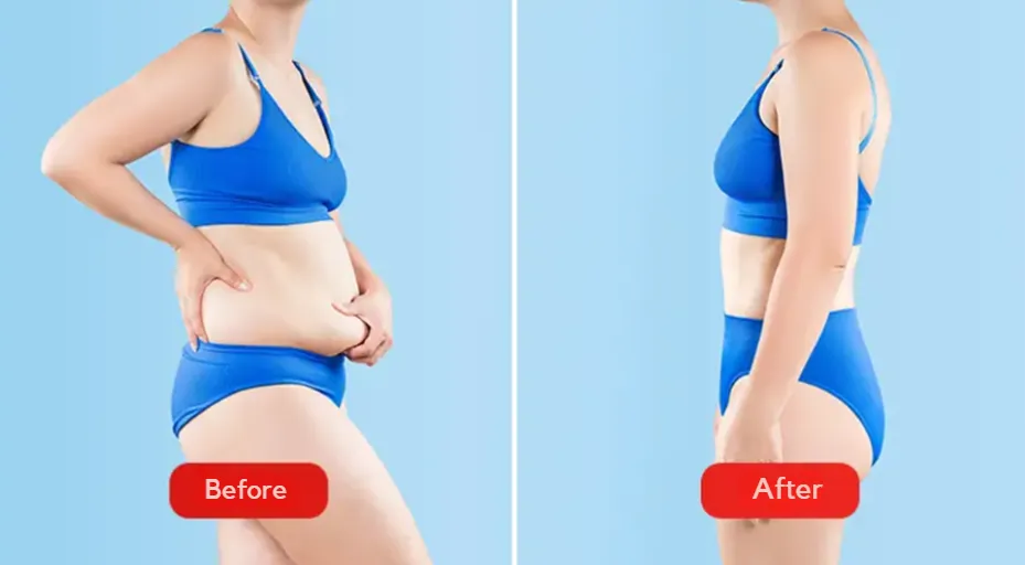 Before and after liposuction procedure in Cluj