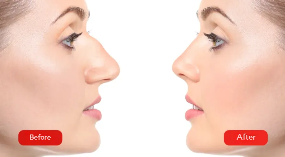 The photo shows the results before and after rhinoplasty at the Venart clinic.