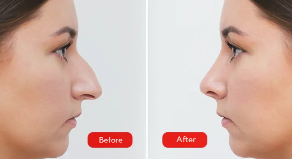 Image that shows before and after Rhinoseptoplasty