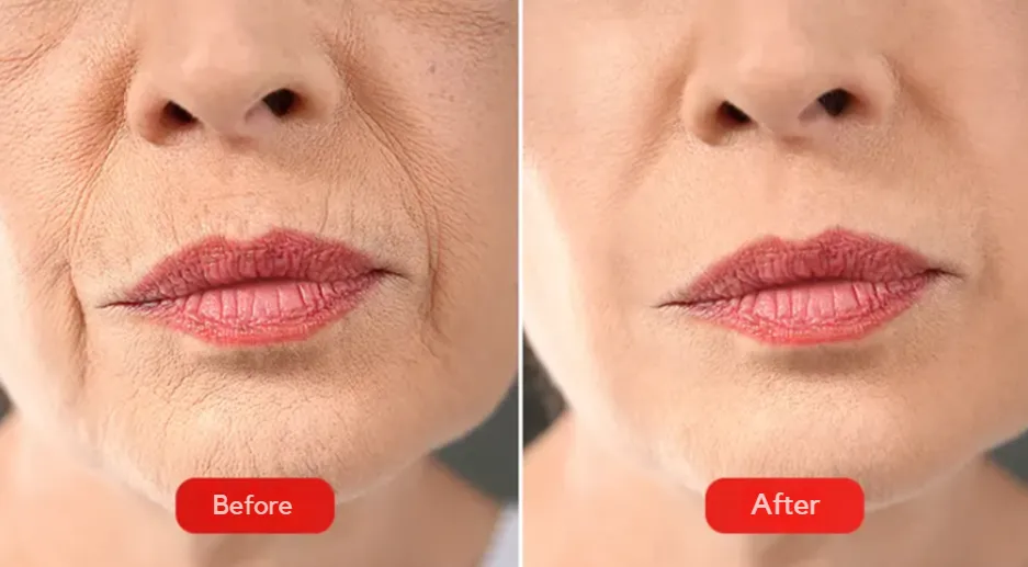 Before and after the hyaluronic acid wrinkle treatment procedure.