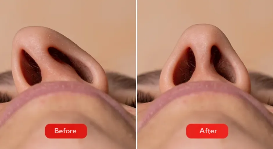 The photo shows the before and after results of the nasal septum improvement procedure, known as septoplasty.
