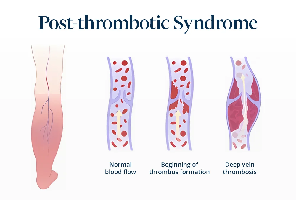 Representative picture of the stages of the postthrombotic embolization procedure.