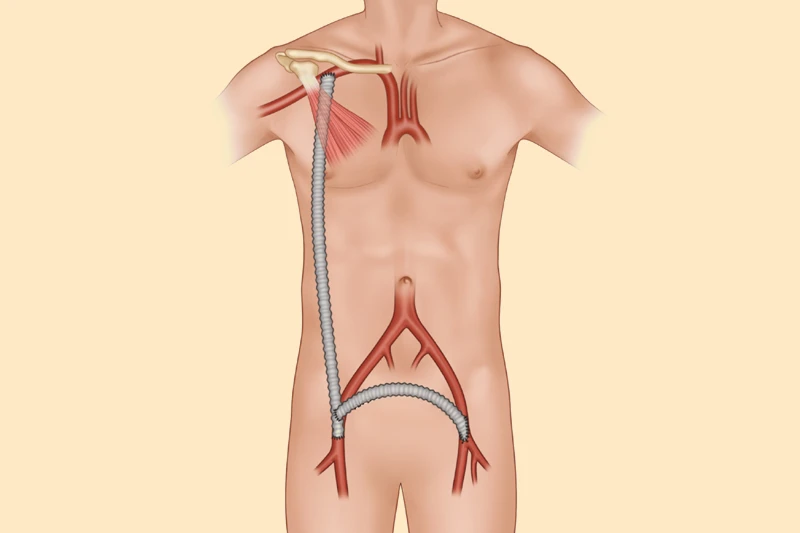 Representative picture of the axillo-bifemoral bypass procedure.