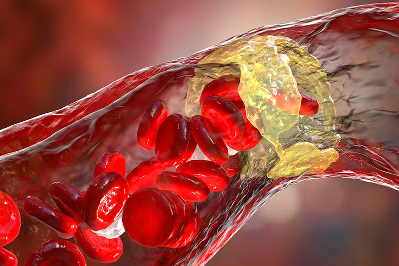 Featured image for the Trombectomy medical procedure page