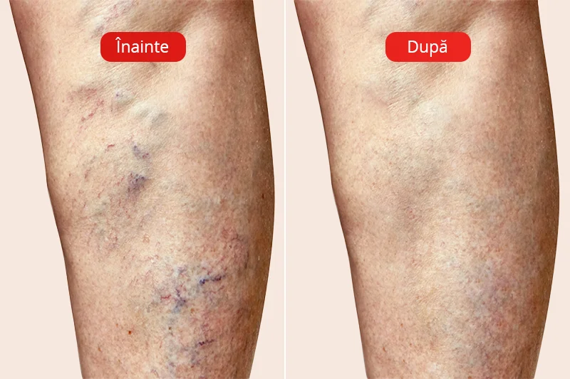Înainte și după tratamentul cu Venosteam la clinica medicală VenArt