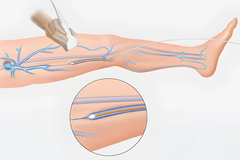 Explanatory picture for the femoral endarterectomy procedure