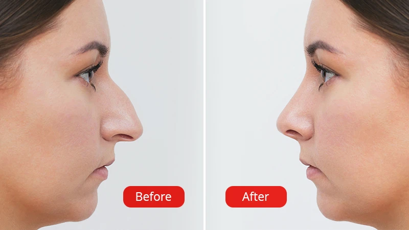 Image that shows before and after Rhinoseptoplasty