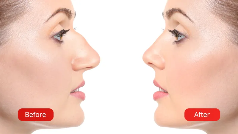 The photo shows the results before and after rhinoplasty at the Venart clinic.