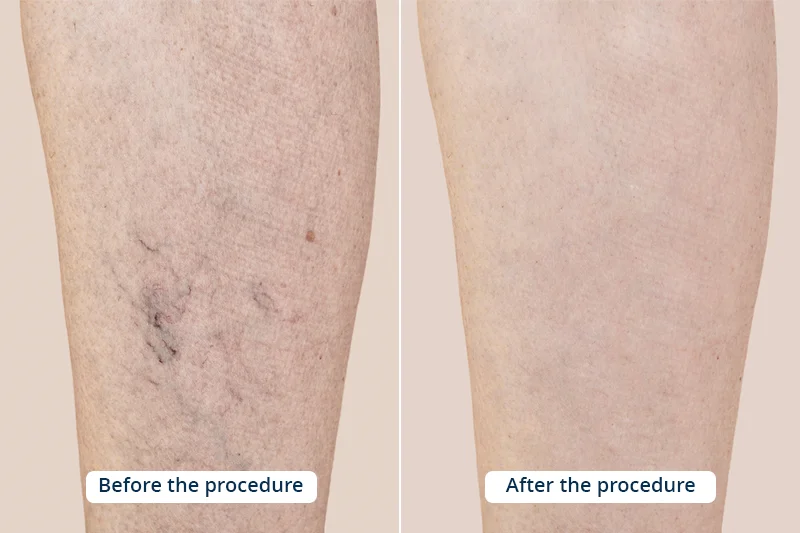 Representative photo showing part of a woman's leg with varicose veins and capillaries before and after medical treatment, sclerotherapy