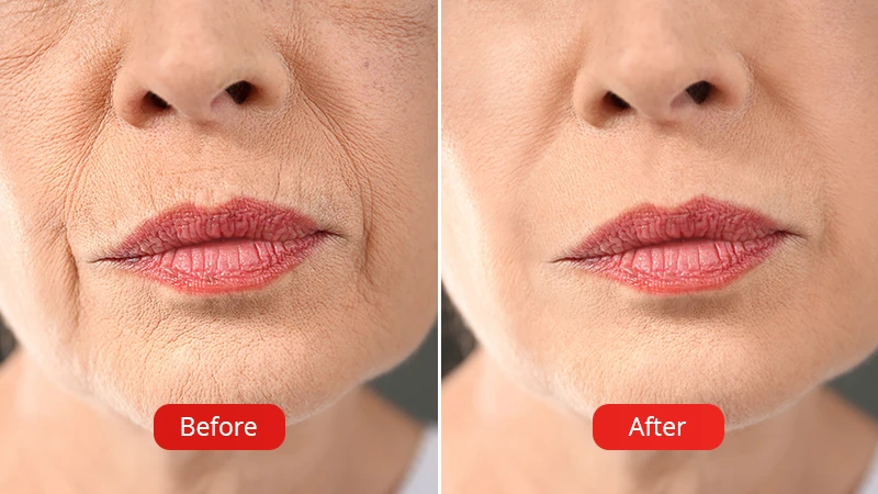 Before and after the hyaluronic acid wrinkle treatment procedure.