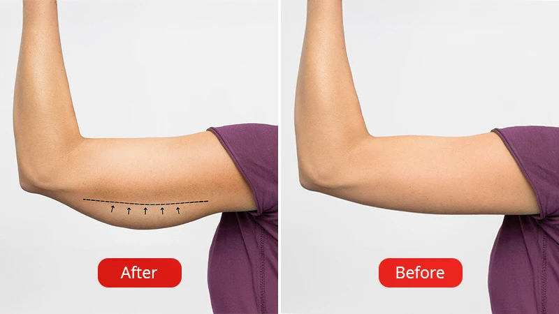 The photo shows the results before and after the brachioplasty procedure at the Venart clinic.