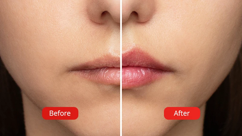 Representative photo for the lip augmentation procedure with hyaluronic acid, showing the results before and after the procedure. 0.5 ml lip shaping with hyaluronic acid