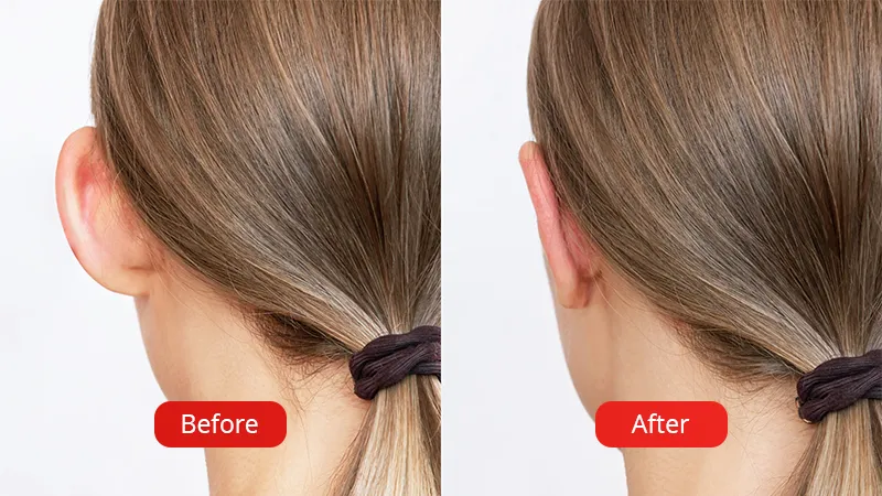 The photo shows the results before and after the otoplasty procedure.