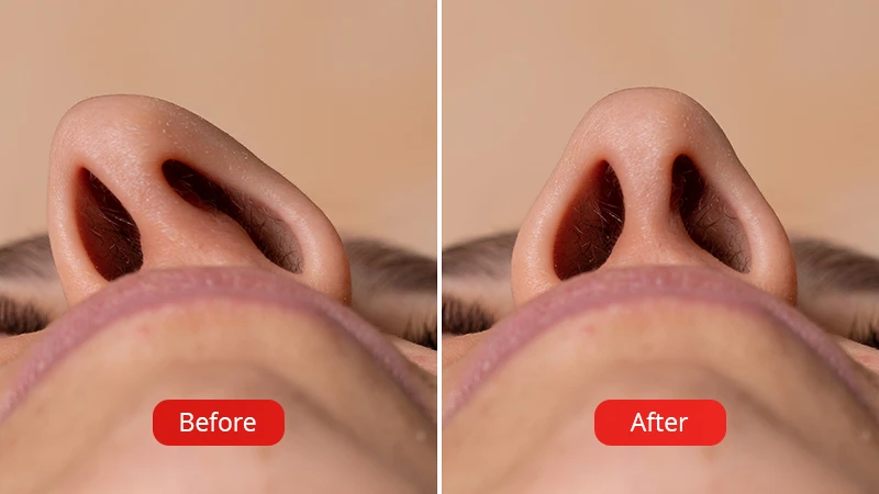 Before and after Septoplasty procedure at VenArt Clinic