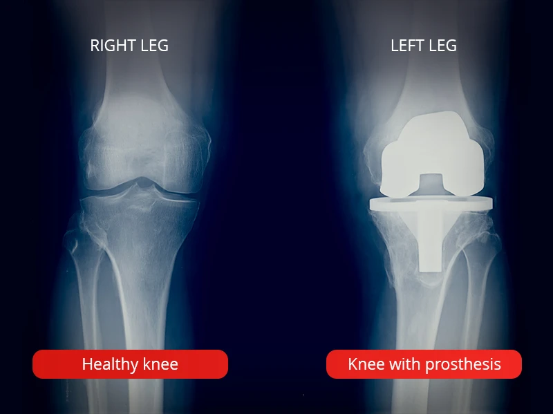 Representative image for total knee replacement surgery.