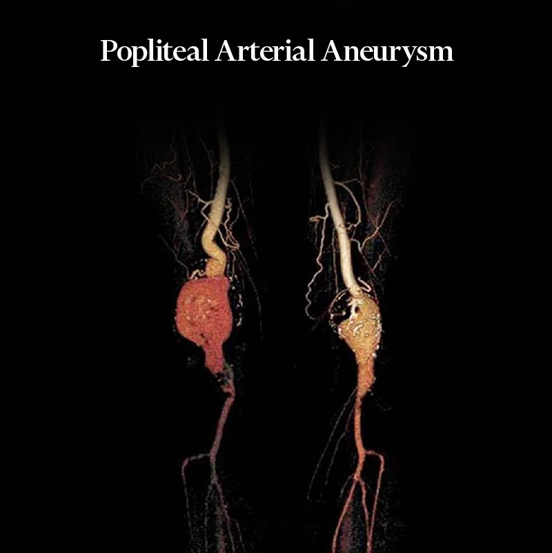 Detailed picture of what a popliteal artery aneurysm looks like