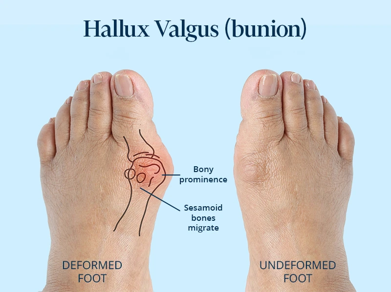 Hallux valgus before and after treatment splints